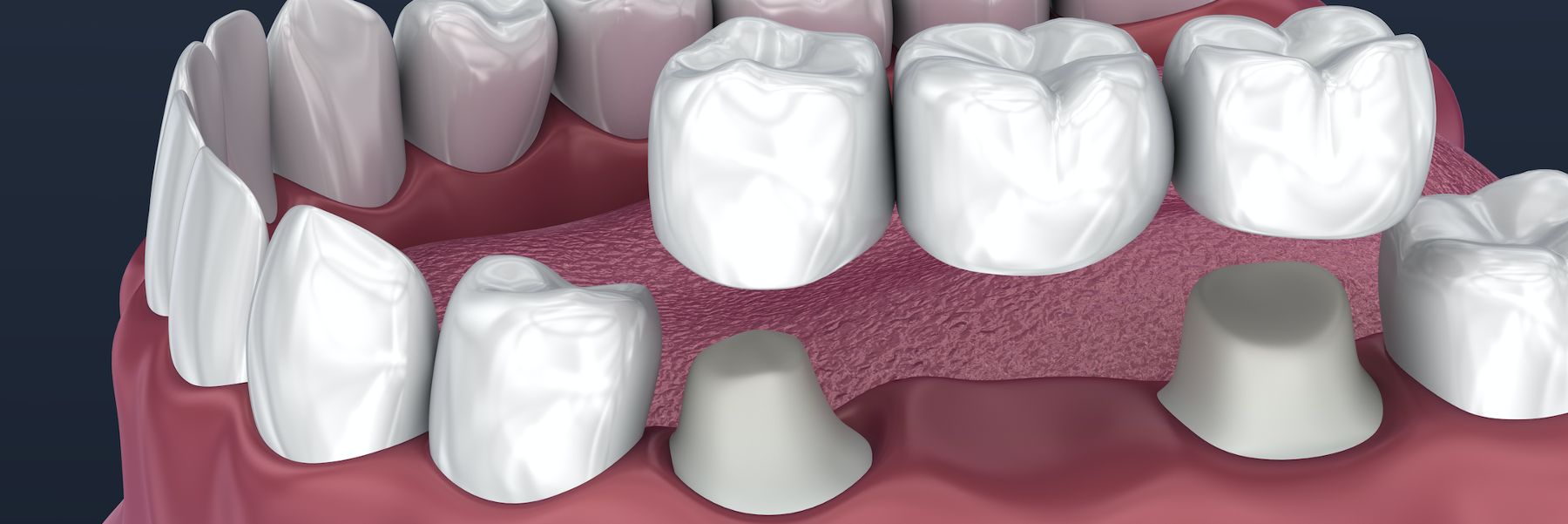 Bridges | Dentist