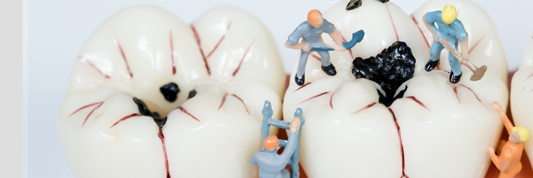 Get white - Amalgam free fillings