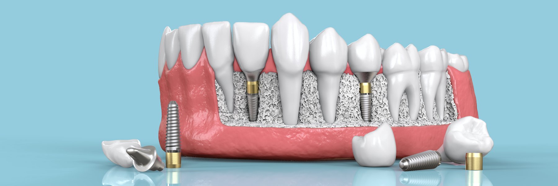 Dental Implants | Dentist